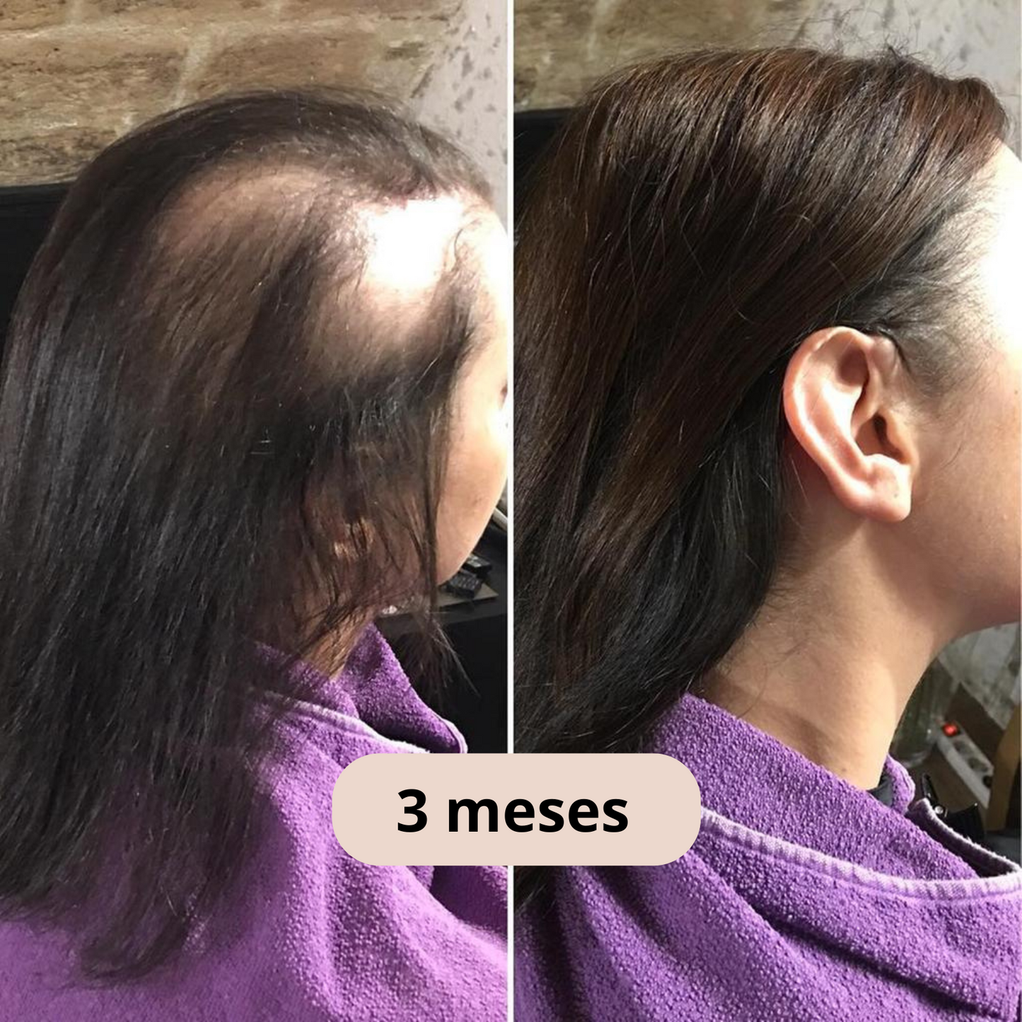 Sozuna-Pro : Bolsa de crecimiento capilar